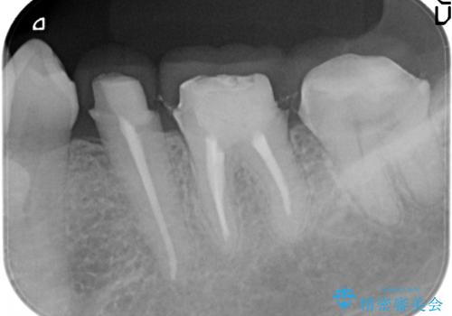 銀歯や古くなったクラウンをやりかえたいの治療中