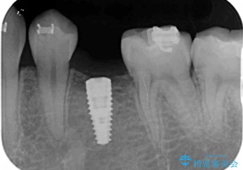 生まれつき歯が少ない　20代でインプラント治療の治療中