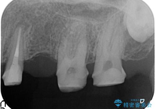 古くなった銀歯をやりかえたいの治療中