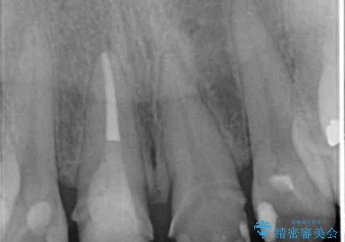 前歯をきれいにしたいの治療中