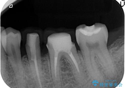 古くなった銀歯をやりかえたいの治療中