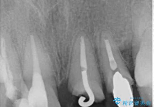前歯をきれいにしたいの治療中
