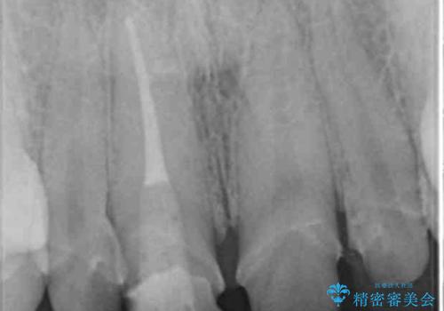[ 前歯のセラミック治療 ]   短期間で歯並びを治したいの治療中