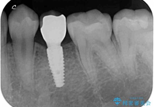 生まれつき歯が少ない 20代でインプラント治療の治療後