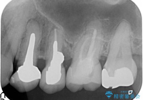 銀歯や古くなったクラウンをやりかえたいの治療前