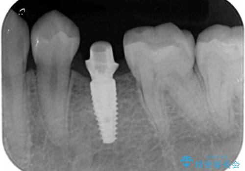 生まれつき歯が少ない　20代でインプラント治療の治療中