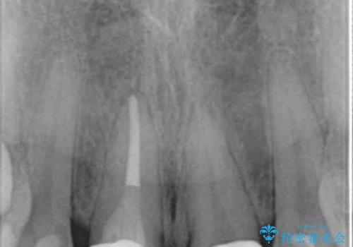 前歯をきれいにしたいの治療後