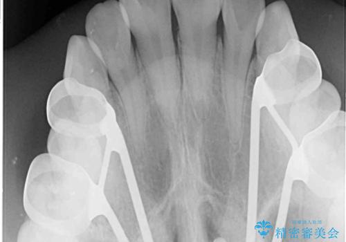 受け口と開咬を急速拡大装置とワイヤー装置で改善の治療中