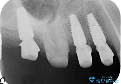 [ インプラントによる機能回復 ]     強い咬合力　放置した虫歯の治療の治療中