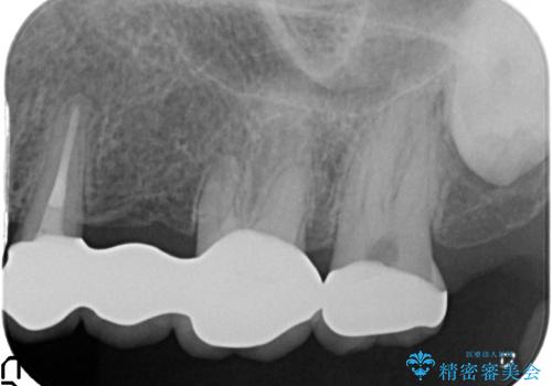 古くなった銀歯をやりかえたいの治療後