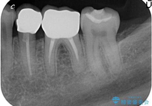 古くなった銀歯をやりかえたいの治療後