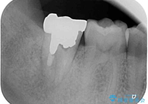 被せものが入れられない 外科処置を行ったセラミック治療の治療前