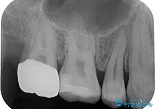 銀の詰め物を白い物にしたいの治療後