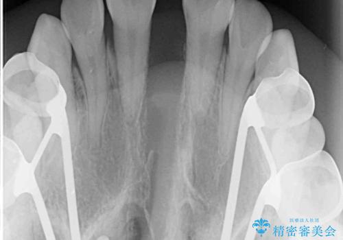 受け口と開咬を急速拡大装置とワイヤー装置で改善の治療後