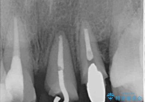 前歯をきれいにしたいの治療中