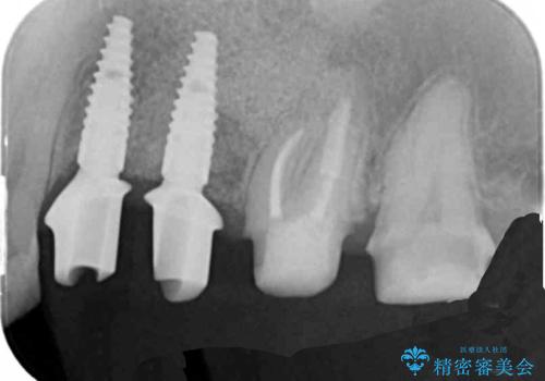 銀歯や古くなったクラウンをやりかえたいの治療中