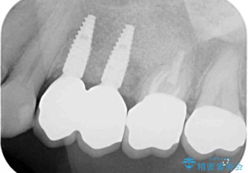 銀歯や古くなったクラウンをやりかえたいの治療後