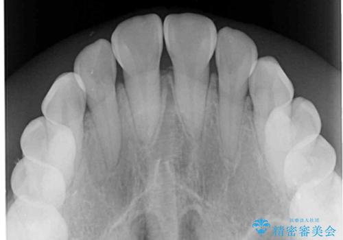 受け口と開咬を急速拡大装置とワイヤー装置で改善の治療前