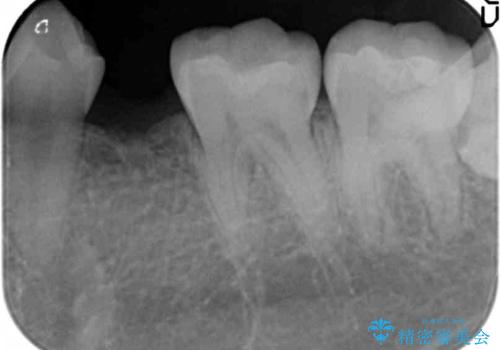 生まれつき歯が少ない　20代でインプラント治療の治療前