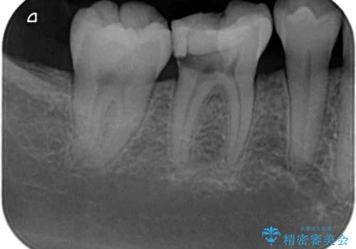 歯が欠けてしみる オールセラミッククラウンによる虫歯治療の治療前