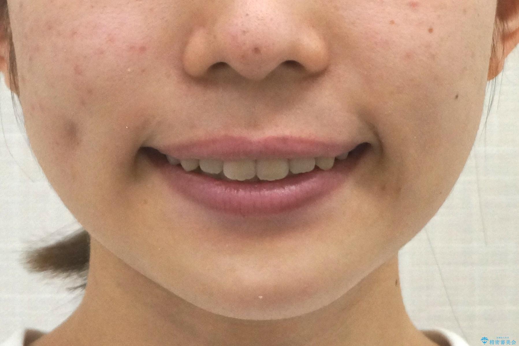 前歯のがたつき　部分矯正でコストダウンしながら、かみ合わせも治療の治療後（顔貌）