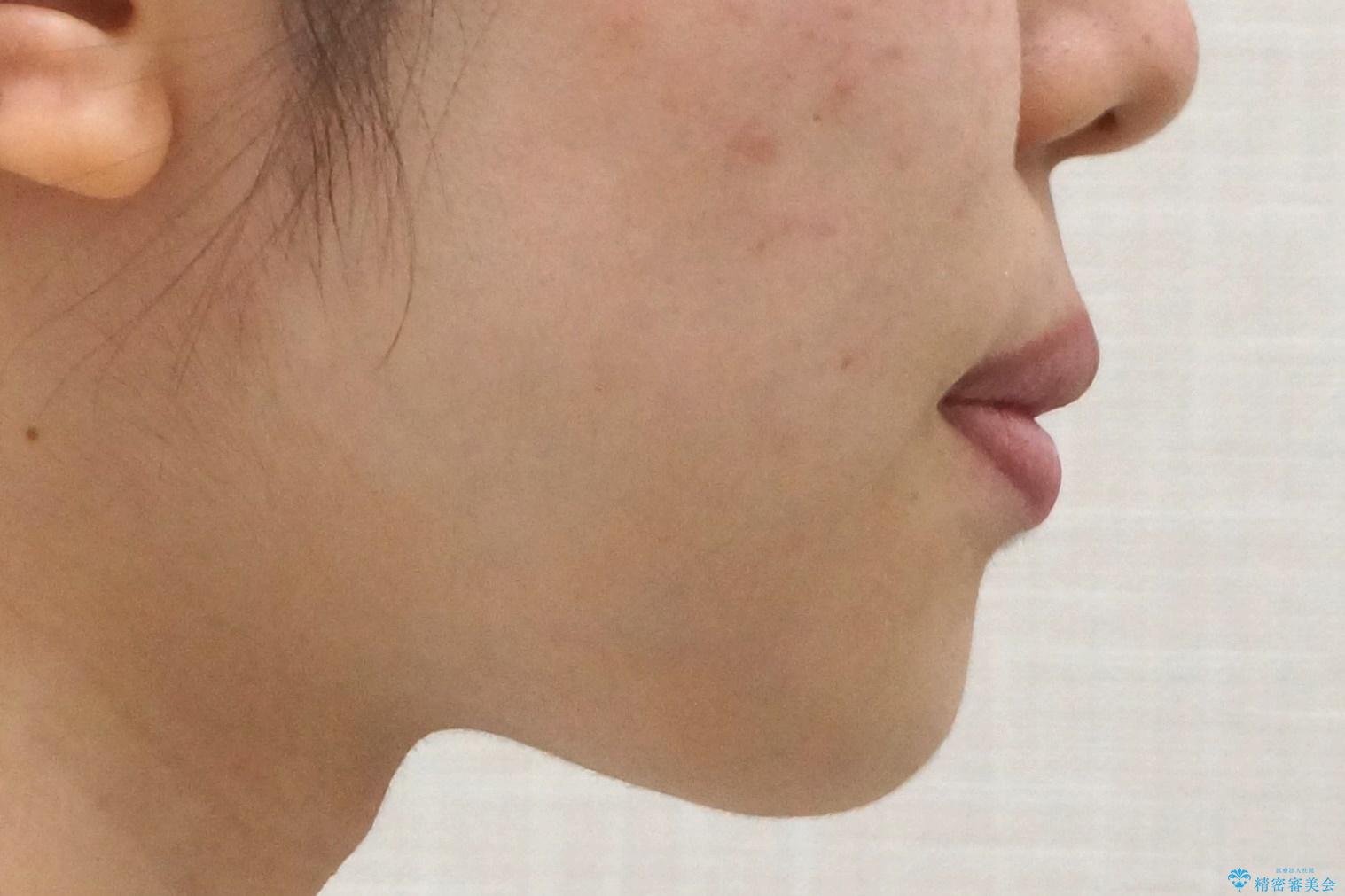 前歯のがたつき 部分矯正でコストダウンしながら、かみ合わせも治療の治療後(顔貌)