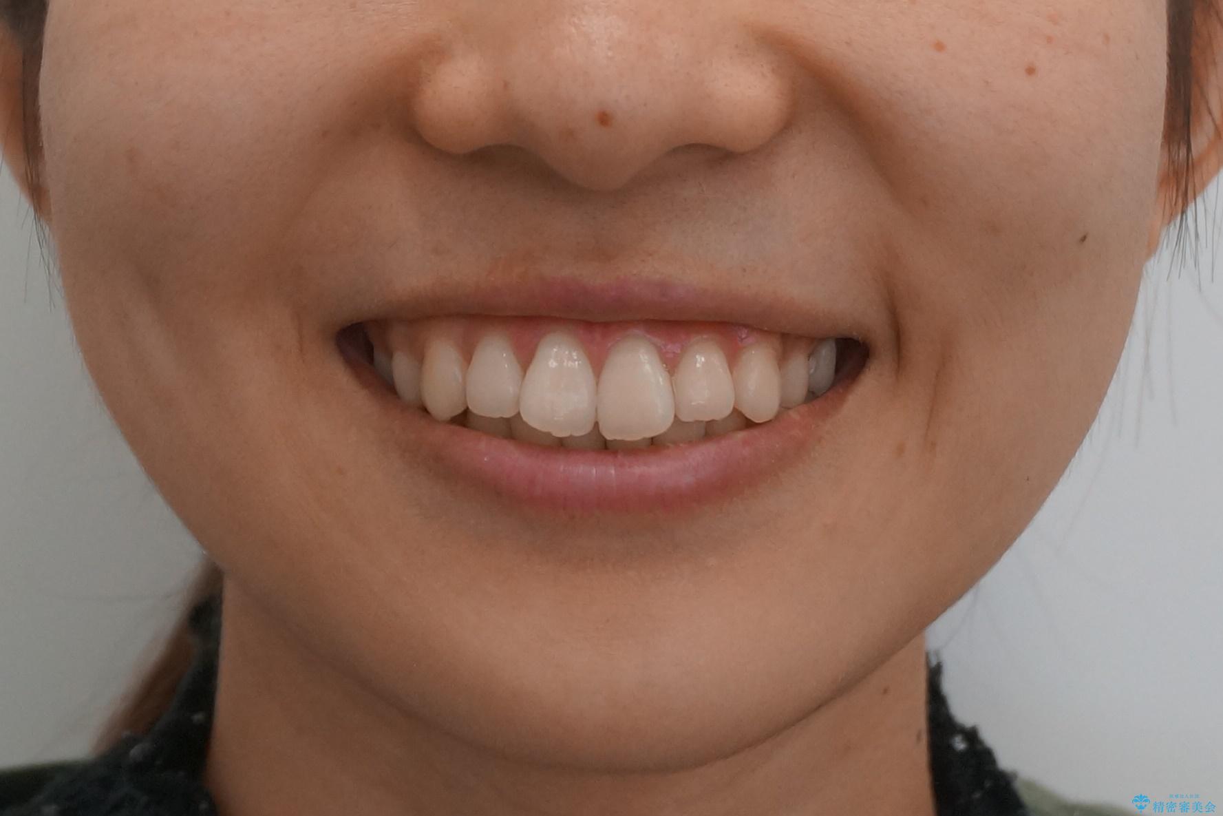 前歯のがたつき　部分矯正でコストダウンしながら、かみ合わせも治療の治療前（顔貌）