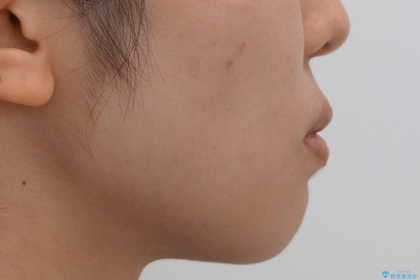 前歯のがたつき 部分矯正でコストダウンしながら、かみ合わせも治療の治療前(顔貌)