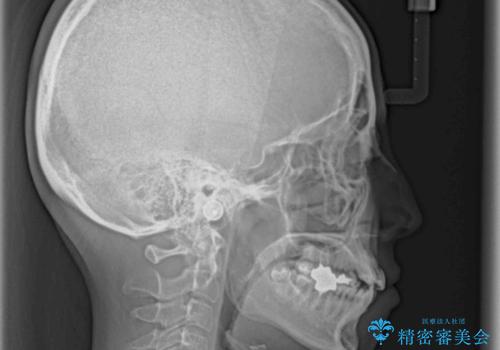 八重歯で口元が膨れている ワイヤー装置での抜歯矯正の治療前