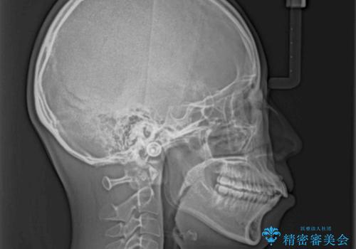 前歯の出っ歯と口の閉じにくさが気になる 目立たないワイヤー装置での抜歯矯正の治療前