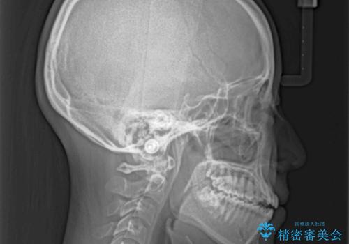 受け口と開咬を急速拡大装置とワイヤー装置で改善の治療前