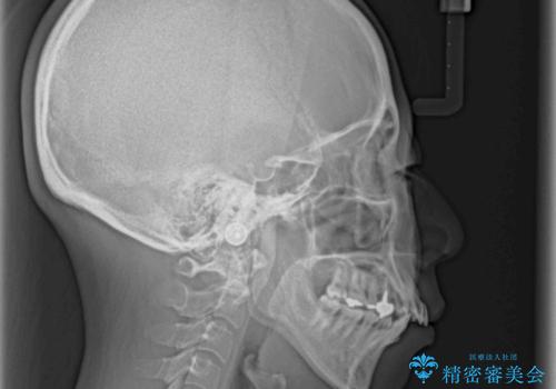 出っ歯による口の閉じにくさを治したい ワイヤー装置を用いた抜歯矯正の治療前