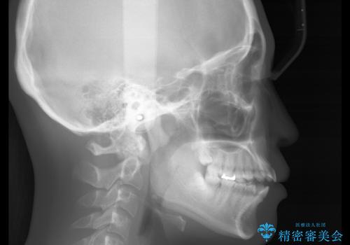 前歯で噛めない:オープンバイト(開咬)を非抜歯インビザラインで治療の治療前