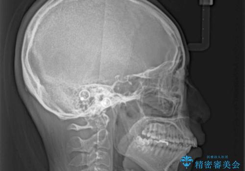 唇を閉じやすく 出っ歯の抜歯矯正の治療前