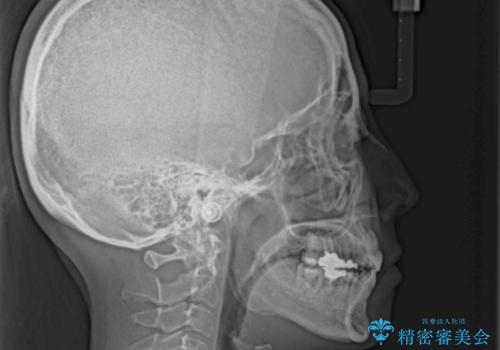 八重歯で口元が膨れている ワイヤー装置での抜歯矯正の治療後