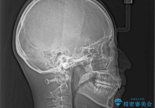 前歯の出っ歯と口の閉じにくさが気になる 目立たないワイヤー装置での抜歯矯正の治療後