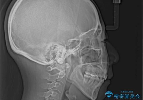 出っ歯による口の閉じにくさを治したい　ワイヤー装置を用いた抜歯矯正の治療後