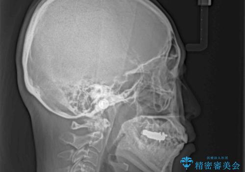 極端な上下前歯の開咬を改善 オープンバイトのインビザライン矯正の治療後