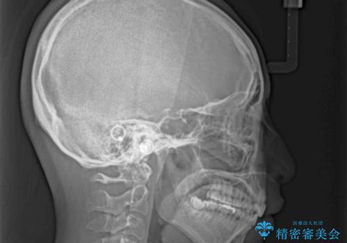 唇を閉じやすく 出っ歯の抜歯矯正の治療後