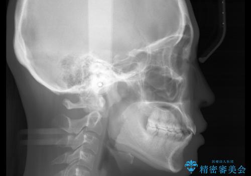 前歯で噛めない:オープンバイト(開咬)を非抜歯インビザラインで治療の治療後