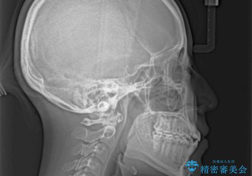 受け口と開咬を急速拡大装置とワイヤー装置で改善の治療後