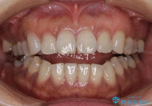 極端な上下前歯の開咬を改善　オープンバイトのインビザライン矯正の症例 治療前