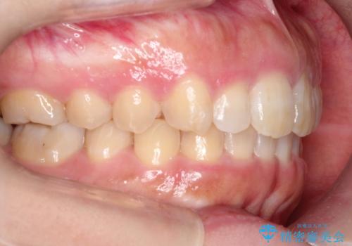 【出っ歯が気になる】インビザライン症例の治療後