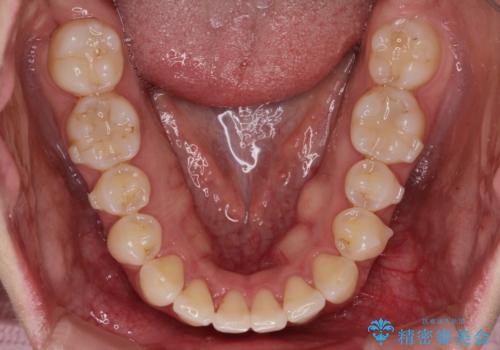 【前歯のガタガタが気になる】インビザライン症例の治療中