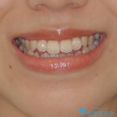 受け口と開咬を急速拡大装置とワイヤー装置で改善の治療前（顔貌）