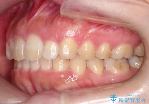 【出っ歯が気になる】インビザライン症例の治療後