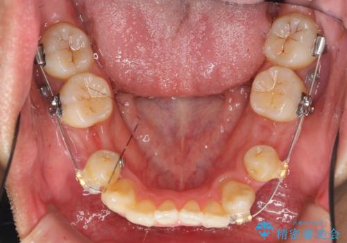 [ 成人矯正 ] 目立つ八重歯を治したいの治療中