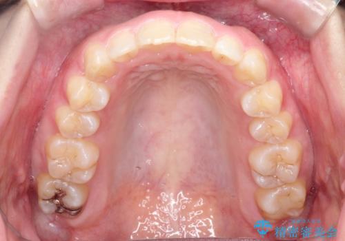 【出っ歯が気になる】インビザライン症例の治療後