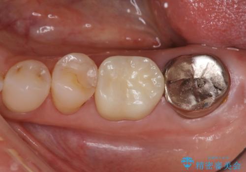 他院で仮歯までしたが、放置していたためセラミック入れたい セラミック治療の治療後