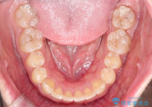 【出っ歯が気になる】インビザライン症例の治療後